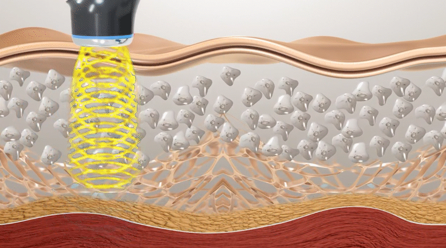 What Is Sonophoresis? The Science Behind Why VividLift Works